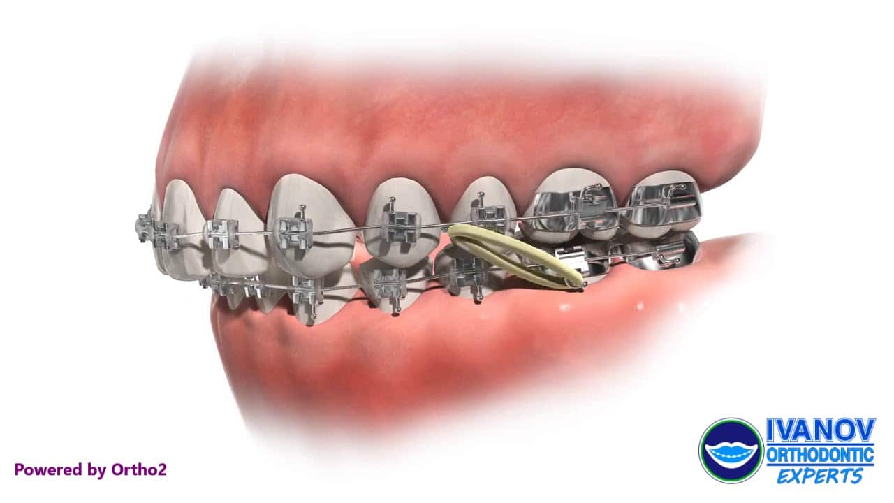 strongest rubber bands for braces