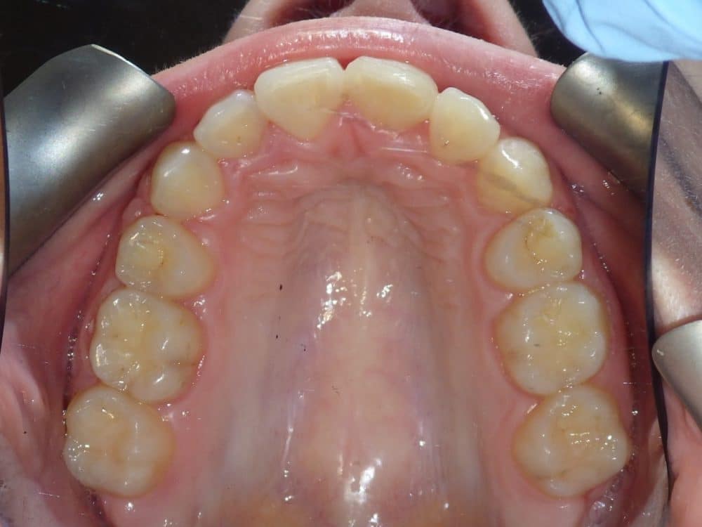 After-patient 4
