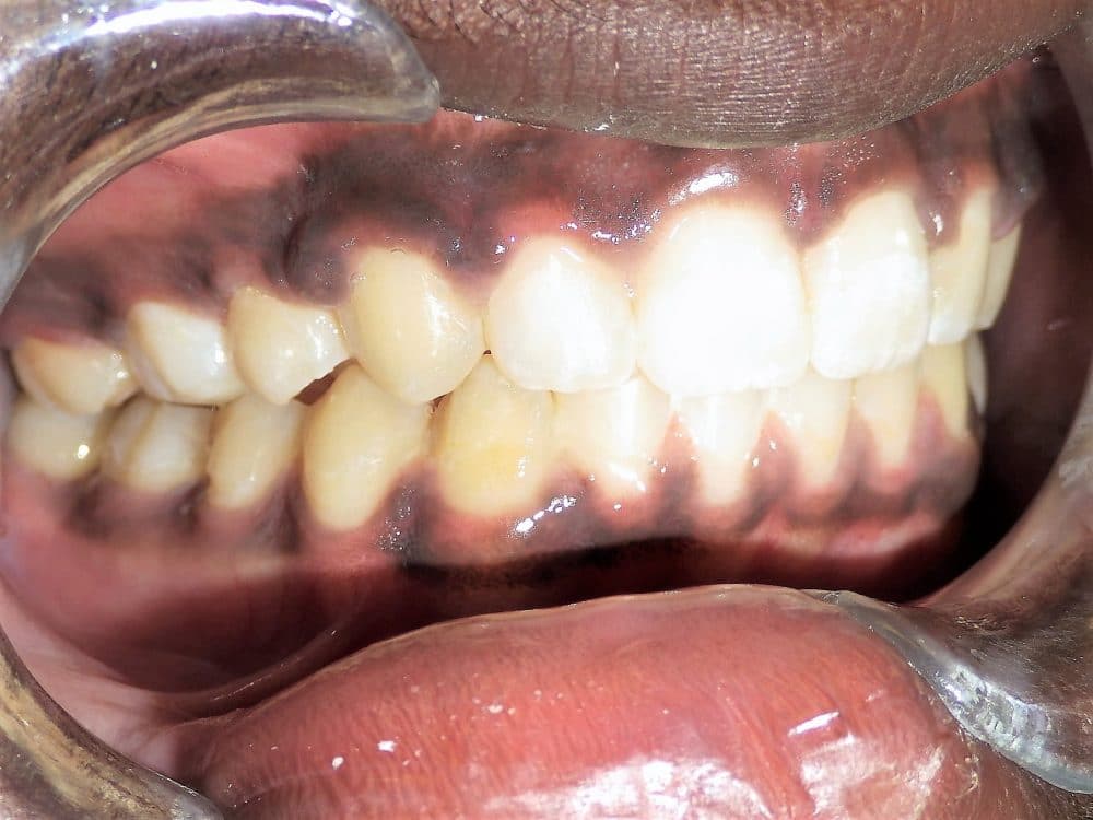 Herbst Appliance - Can Often Correct Severe Overbites without Braces