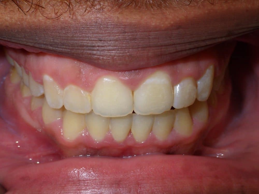 After-patient 9