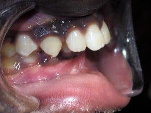 Braces Before and After Overbite: Causes, Symptoms, Treatments