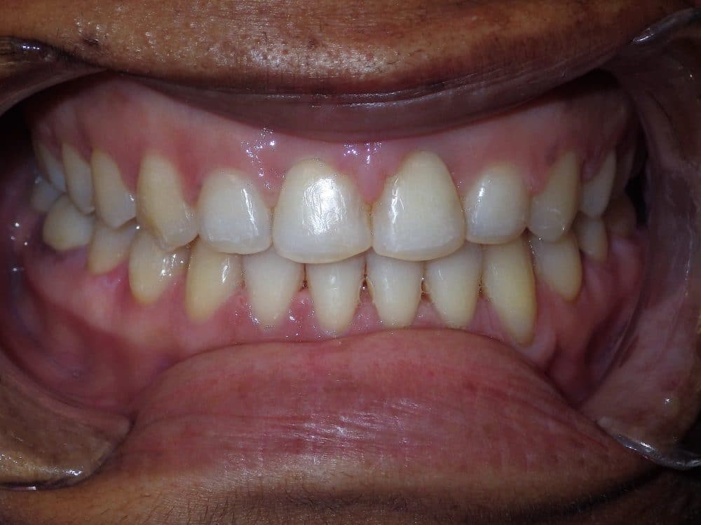 After-patient 5