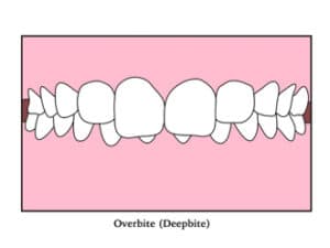 Overbite vs. Overjet - Ridgewood, NJ