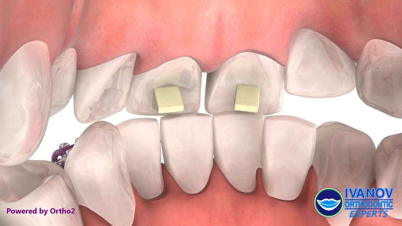 How Do Orthodontic Care Specialists Provide A Beautiful Smile? bite-turbos