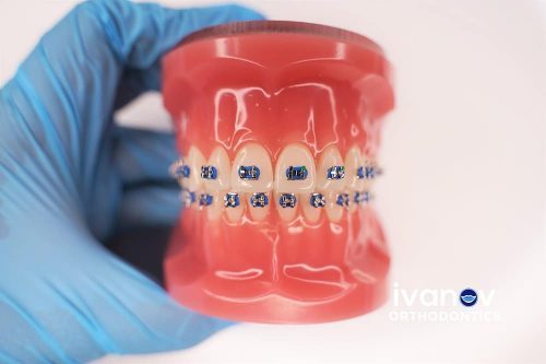 Early Treatment - Prairie Pointe Orthodontics