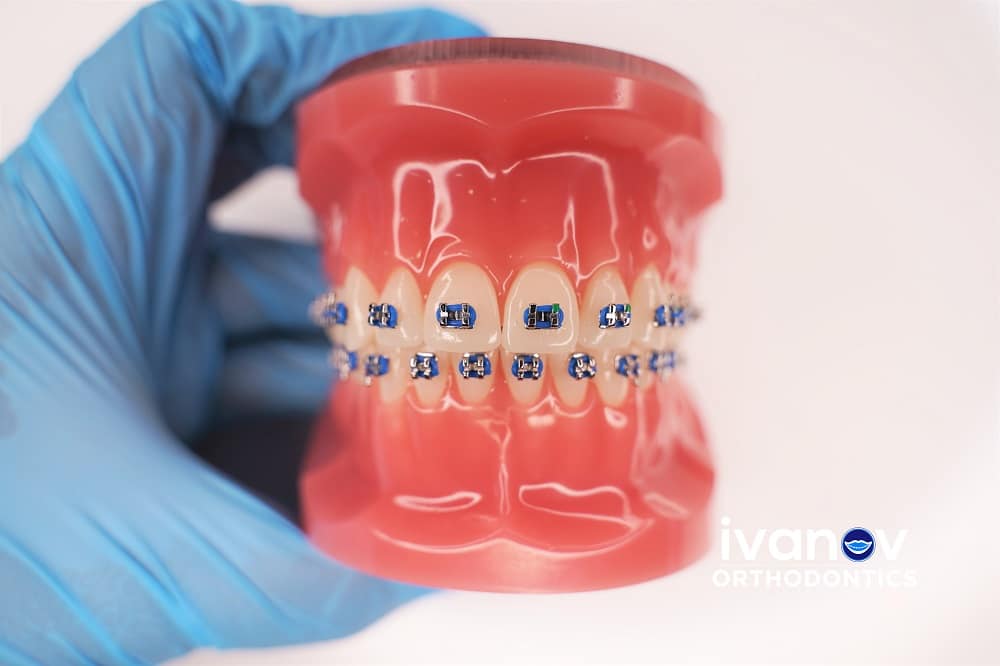 What Can Rubber Bands Do for My Bite? - iSmile Orthodontics