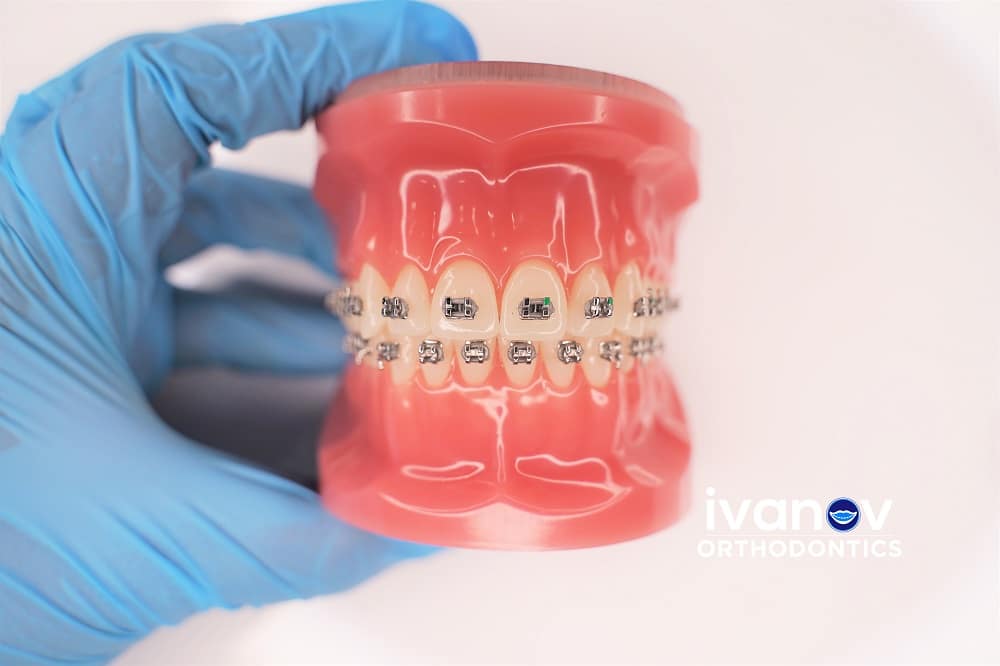 Braces With Missing Teeth | Teeth Alignment Treatment