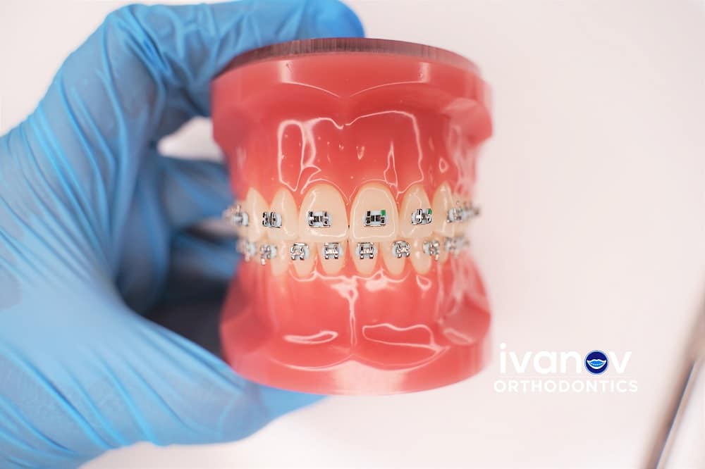 Why Do Orthodontists Prescribe Braces for Impacted Teeth?