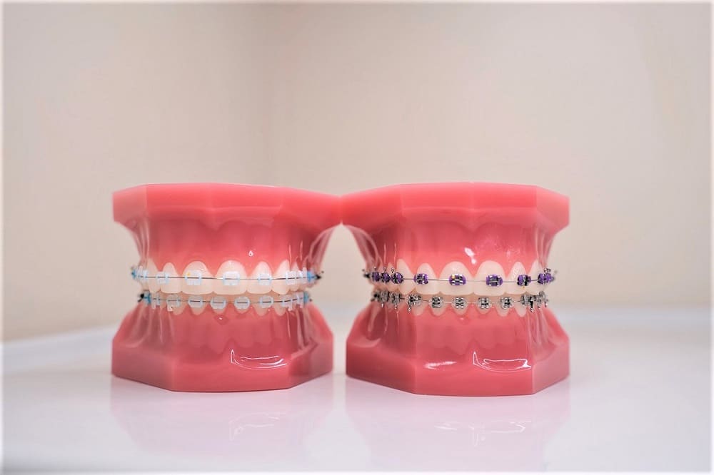 How Much Are Clear Braces - Are They Worth It