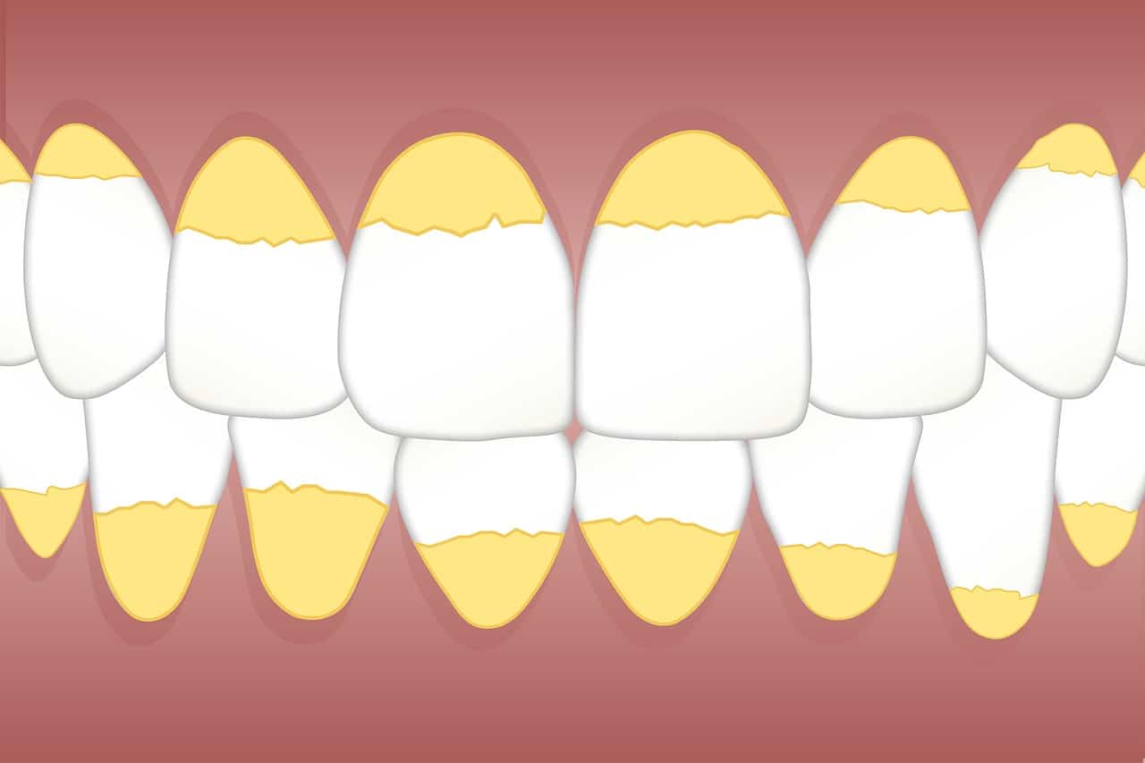 Plaque vs. Tartar