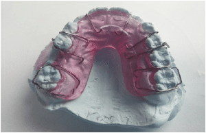 How long do you need to wear a retainer