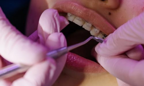 ceramic braces ceramic braces