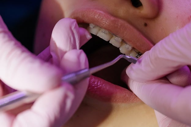 The Pros and Cons of Ceramic Braces