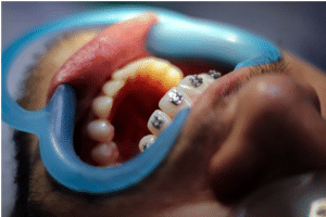 types of braces