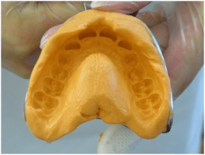 brace removal and after braces dental care