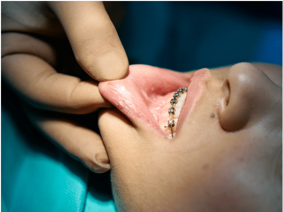 Cost of Invisalign vs. Cost of braces