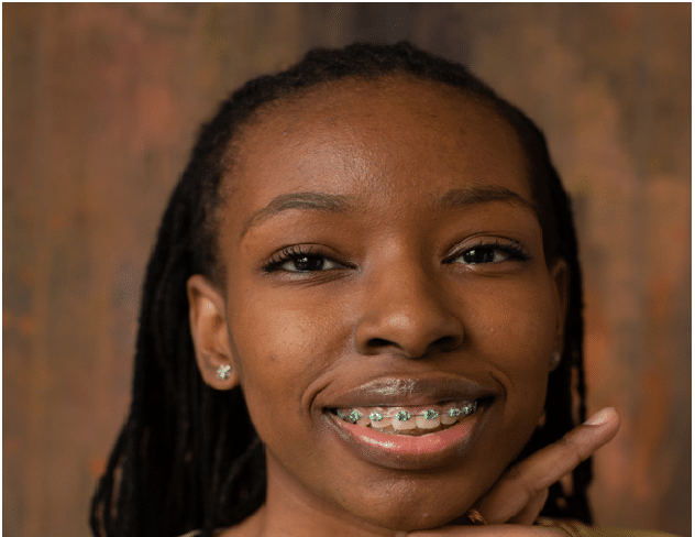 How do Self Ligating Braces Work