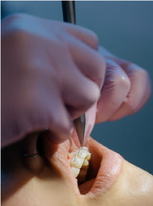 Invisible braces and retainers for straight teeth
