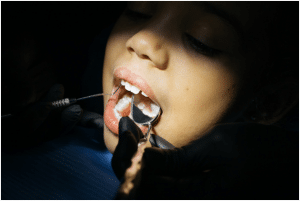 childhood dental