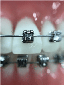 How Long Do Adults Wear Braces For