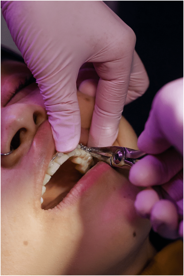How to remove braces
