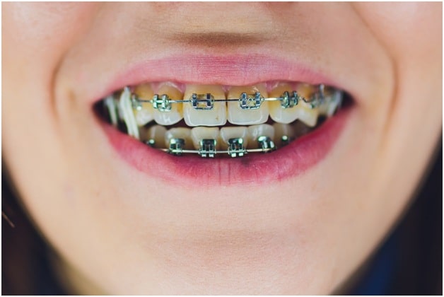 What Are Elastics for Braces?