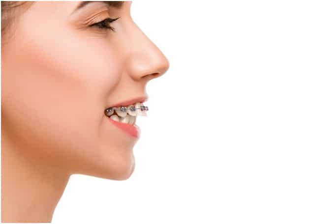 Overjet Vs. Overbite: What's The Difference?