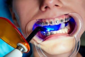 adult-orthodontics-miami