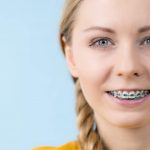 brace-teeth-near-me