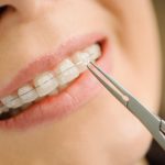 best-braces-prices-near-me