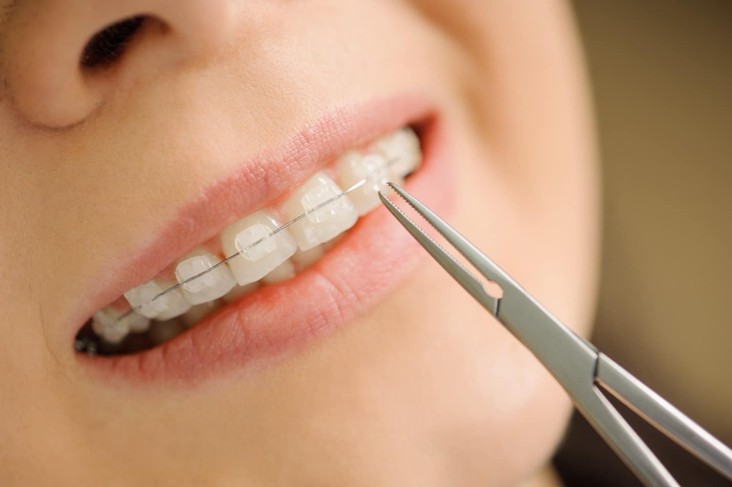 How Much Do Braces Cost?, Braces Price