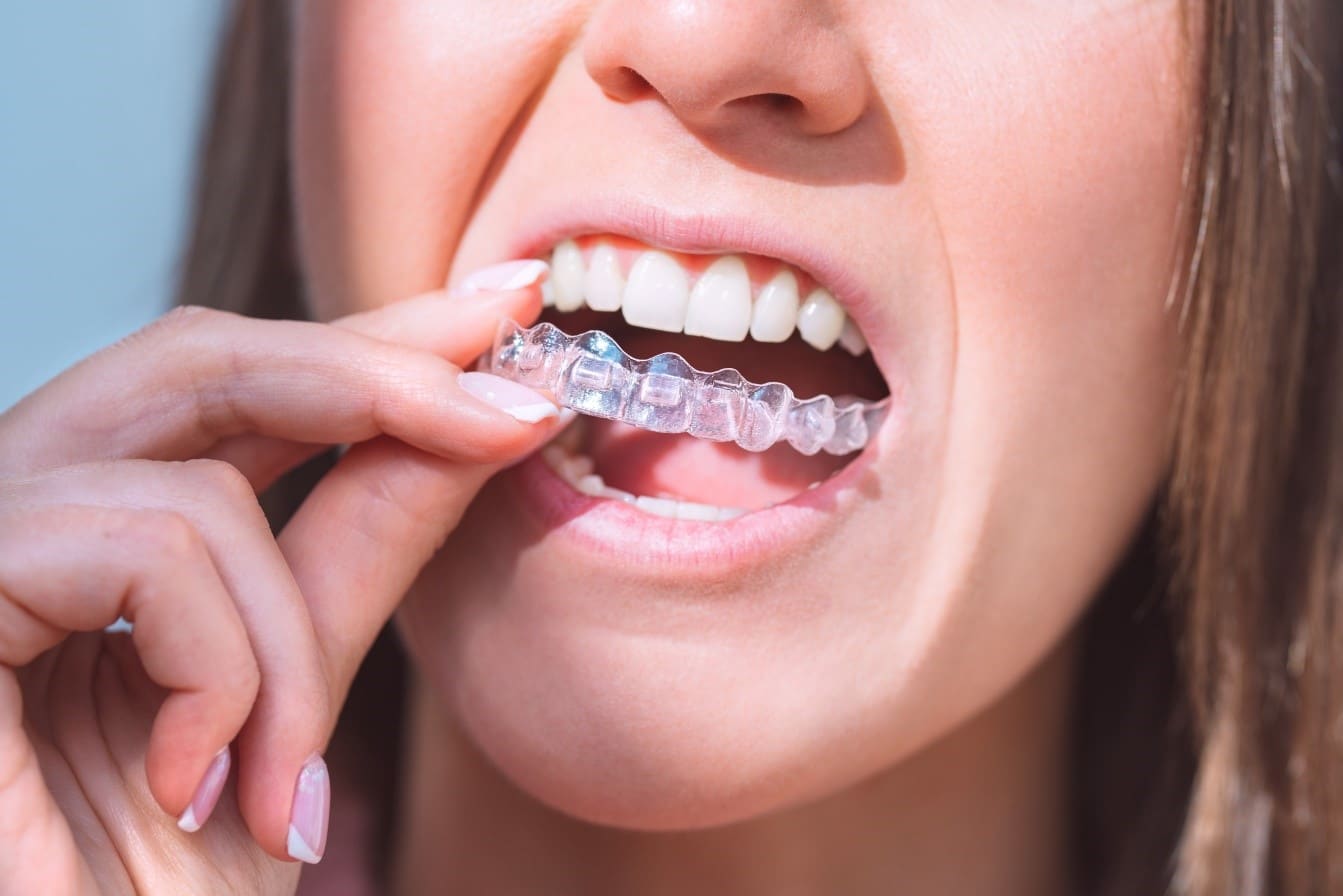 Should You Choose Ceramic Braces or Invisalign? Local Orthodontic