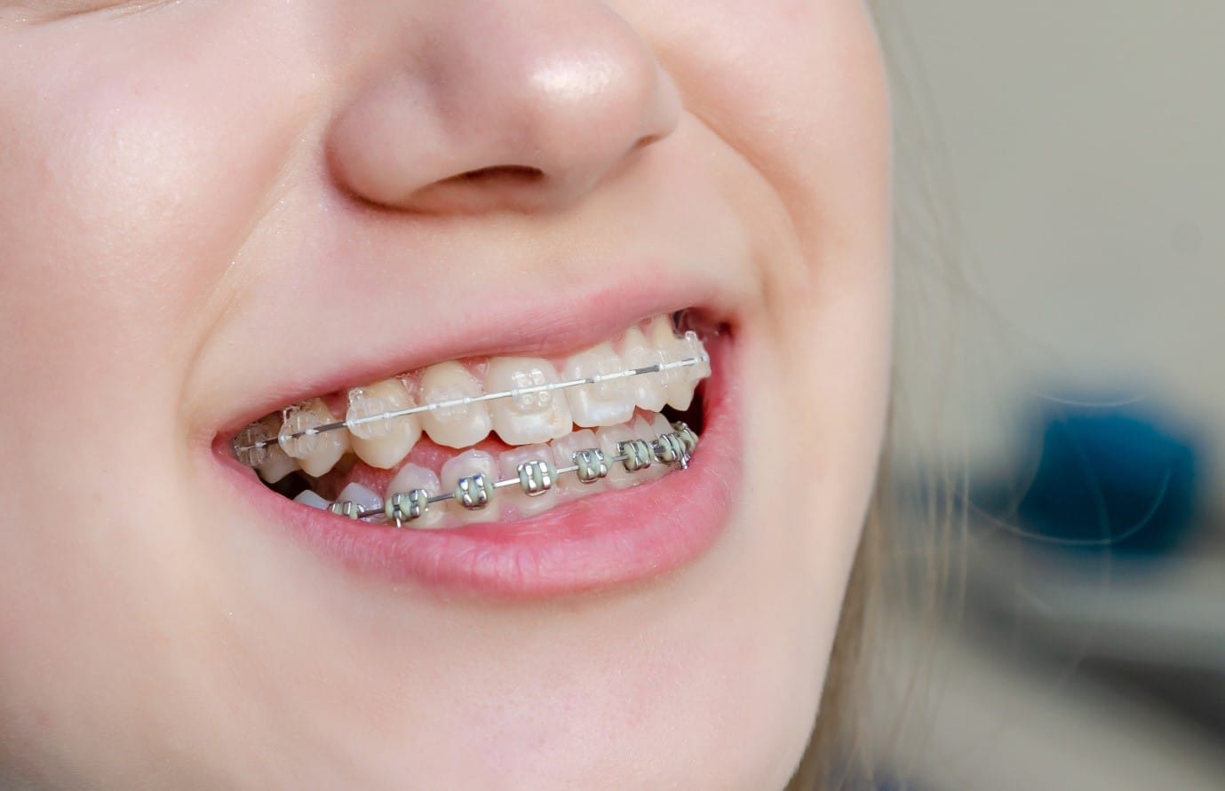 Welcome to a New Look Of clear aligners