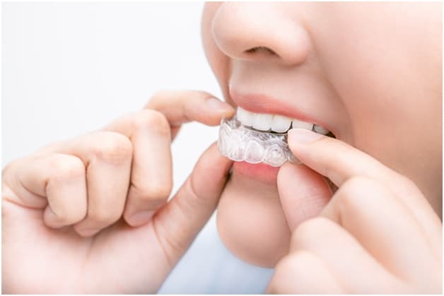 Are braces rubber bands used with Invisalign too?