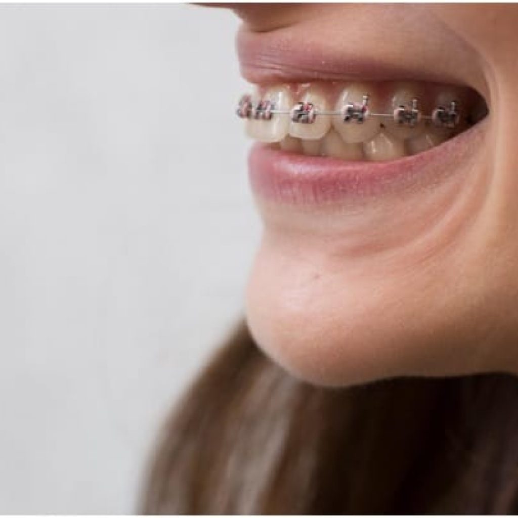 braces only on bottom teeth