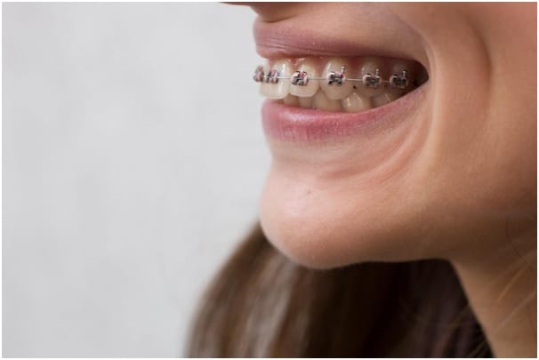 Braces on Just Upper or Lower Teeth Miami