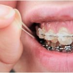 LightForce Braces
