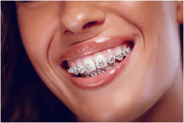 Ceramic Braces  Grant Orthodontics