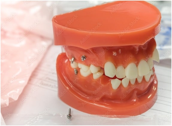 What Do Rubber Bands Do on Braces? - OC Dental Center