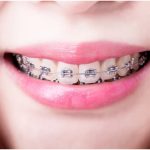 metal brace