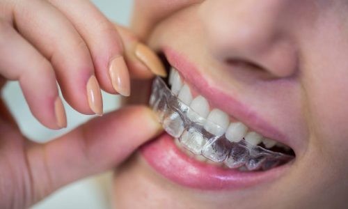 clear aligners clear aligners