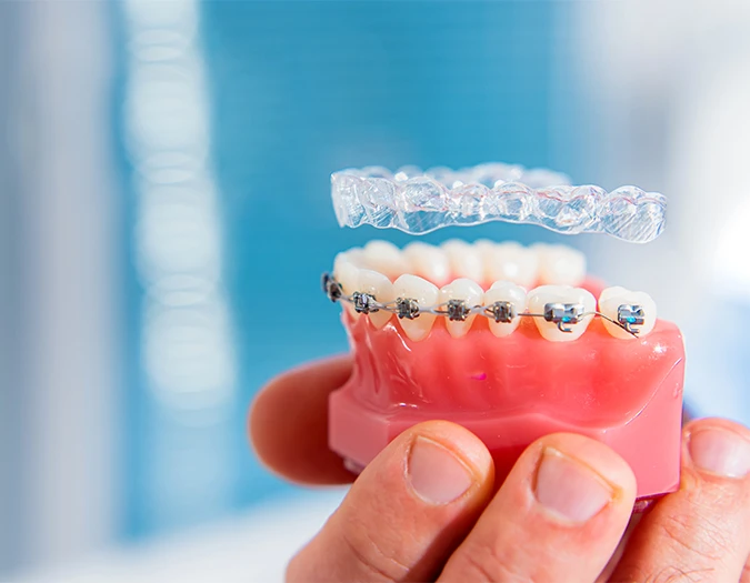 Avoid These Missteps When Undertaking Invisalign Treatment