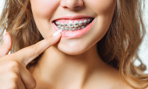 self ligating braces self ligating braces