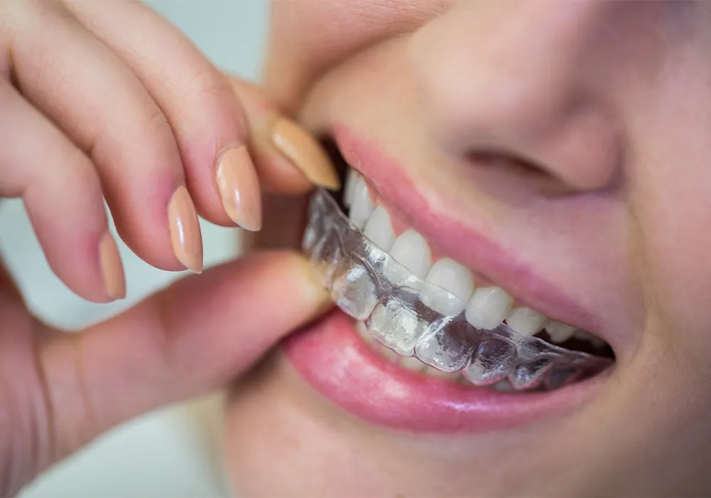 Dental Braces: Types, Care, What To Expect - Miami Orthodontist Group