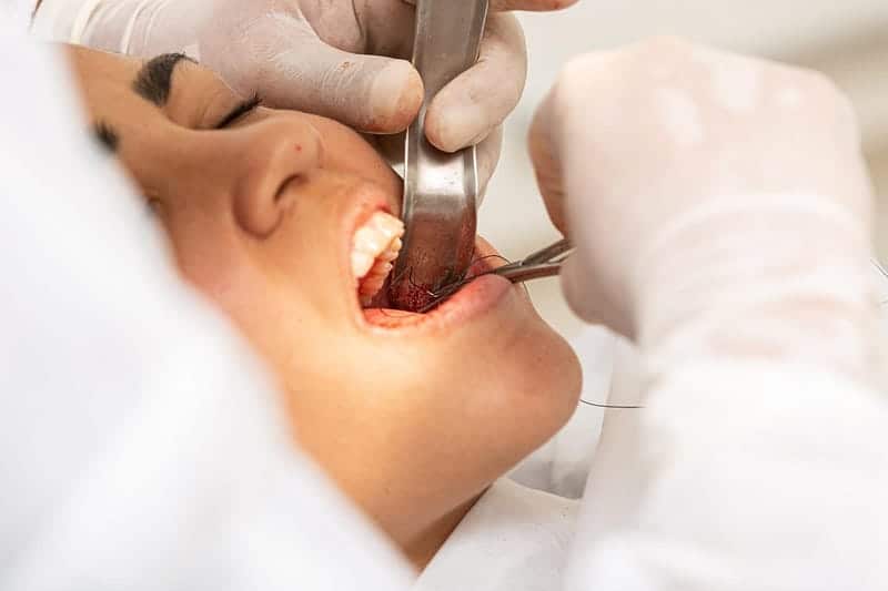 Tooth Extraction