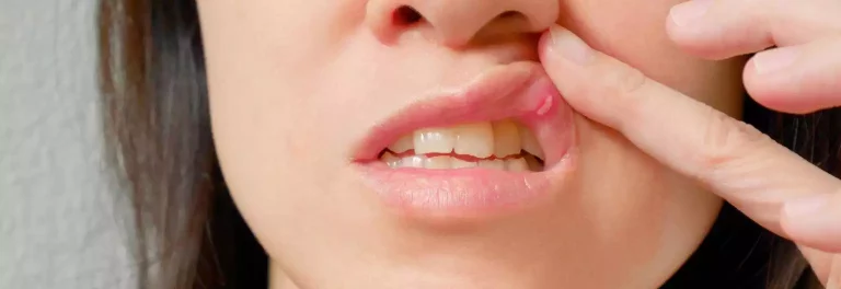 Remedy for canker sore