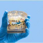 Fix an Uneven Jaw with Braces