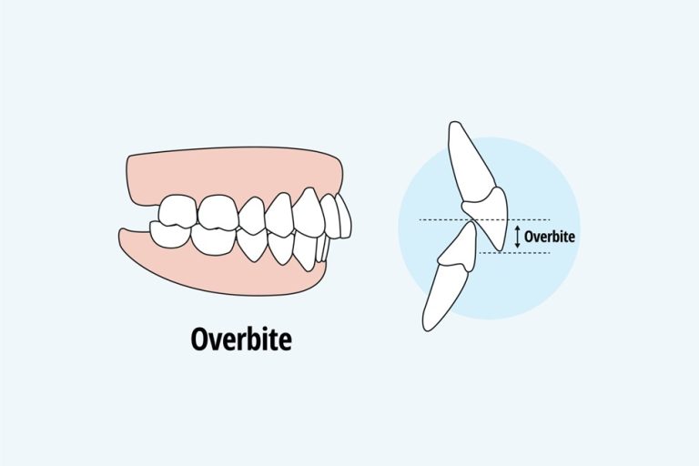 Classifications of Teeth Arrangement in Orthodontics