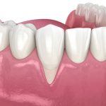 Exposed Tooth Root