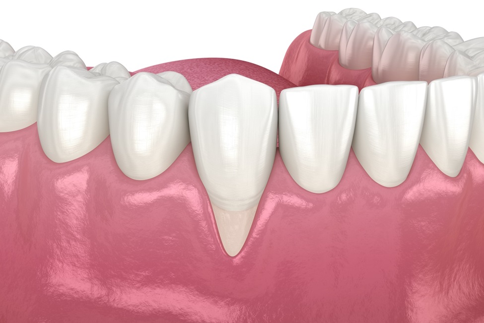 Exposed Tooth Root